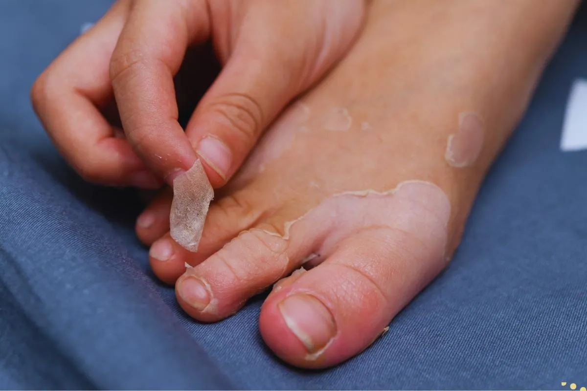 what-is-the-spiritual-meaning-of-peeling-skin-of-hands-and-feet